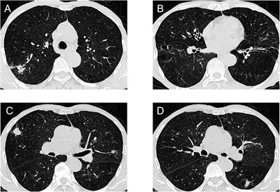 A rare case report: co-occurrence of two types of lung cancer with hamartoma and pulmonary tuberculosis